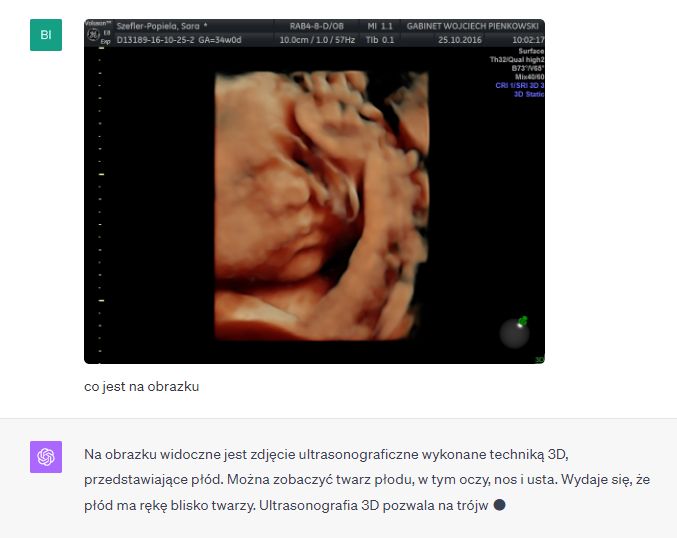 Na obrazku widoczne jest zdjęcie ultrasonograficzne wykonane techniką 3D, przedstawiające płód. Można zobaczyć twarz płodu, w tym oczy, nos i usta. Wydaje się, że płód ma rękę blisko twarzy