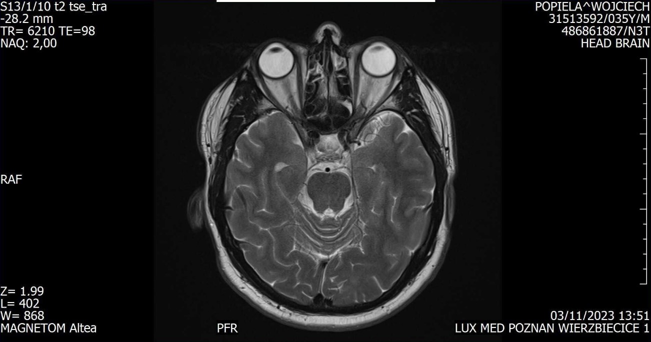 Widok mózgu uzyskany podczas badania obrazowego